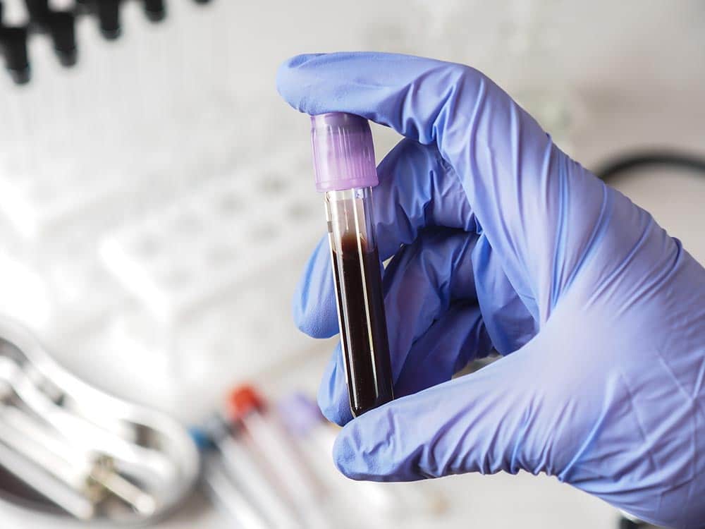 Θεραπεία με PRP